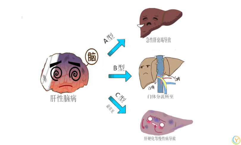 肝硬化逆转很难？医生告诉你：长寿的患者，基本都有这3个共同点！