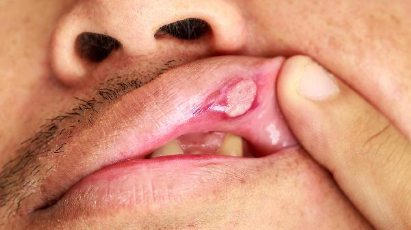 口腔溃疡是因为缺少维生素？三个误导人的常识，今天总算弄清了