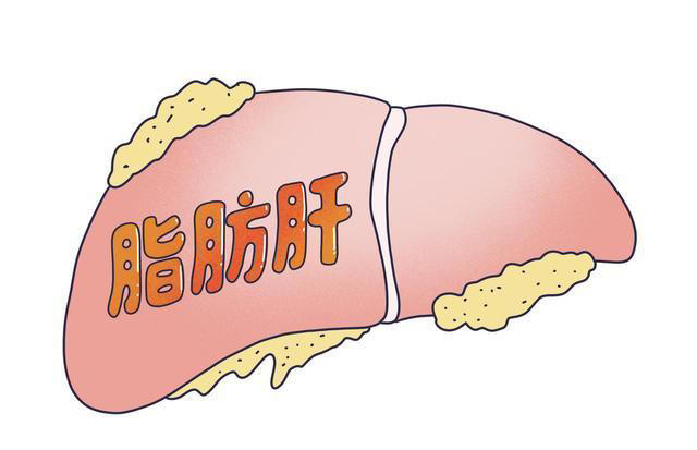 脂肪肝一个鸡蛋都不能吃? 建议:不想肝硬化,4种食物尽量少吃