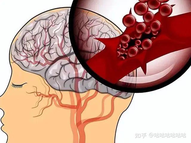脑梗到底是什么，什么样的症状就是脑梗了呢？