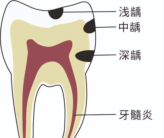 牙齿一咬就疼是怎么回事，该怎么办？