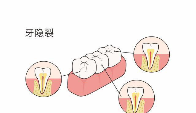 牙齿一咬就疼是怎么回事，该怎么办?