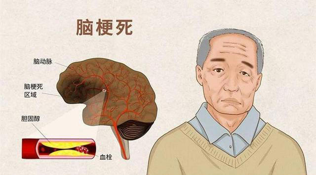 脑梗与睡觉有关？医生多次强调：脑梗患者，睡觉切记5不要