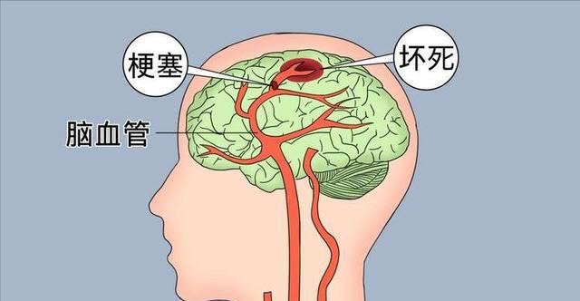 脑梗与睡觉有关？医生多次强调：脑梗患者，睡觉切记5不要