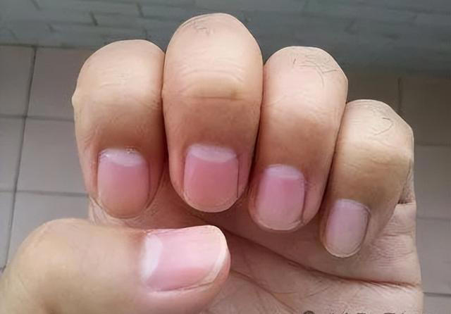 指甲上长有“竖纹”？医生提醒：可能是“这3种病”已近身，自检