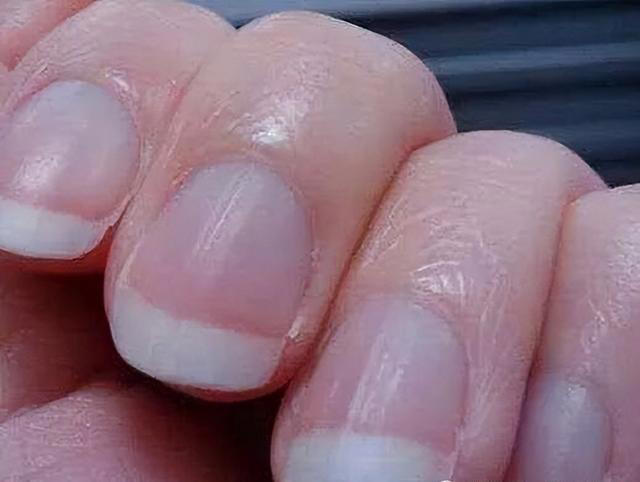 指甲上长有“竖纹”？医生提醒：可能是“这3种病”已近身，自检