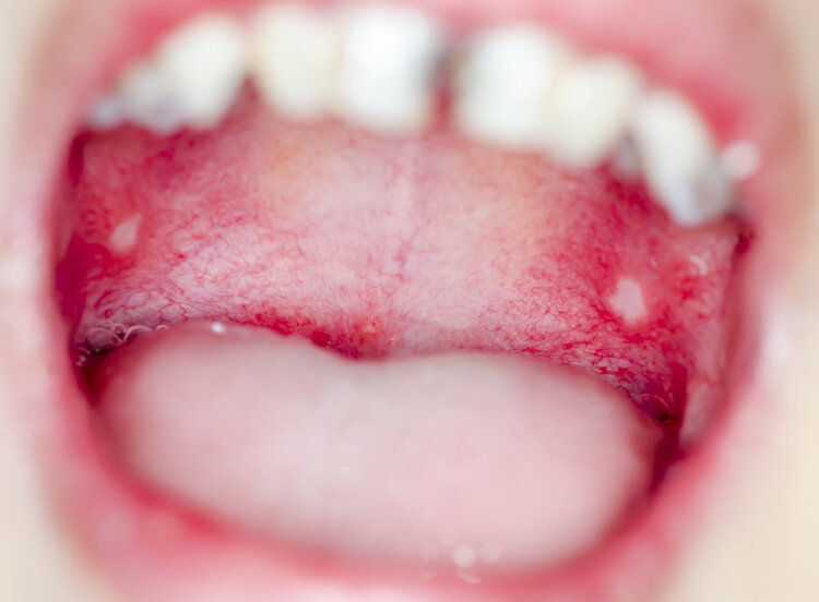 有一种痛叫口腔溃疡!提醒:补充维C不顶用