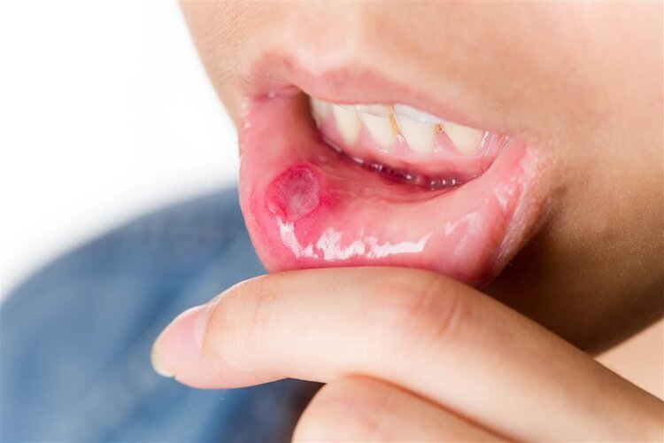 有一种痛叫口腔溃疡!提醒:补充维C不顶用