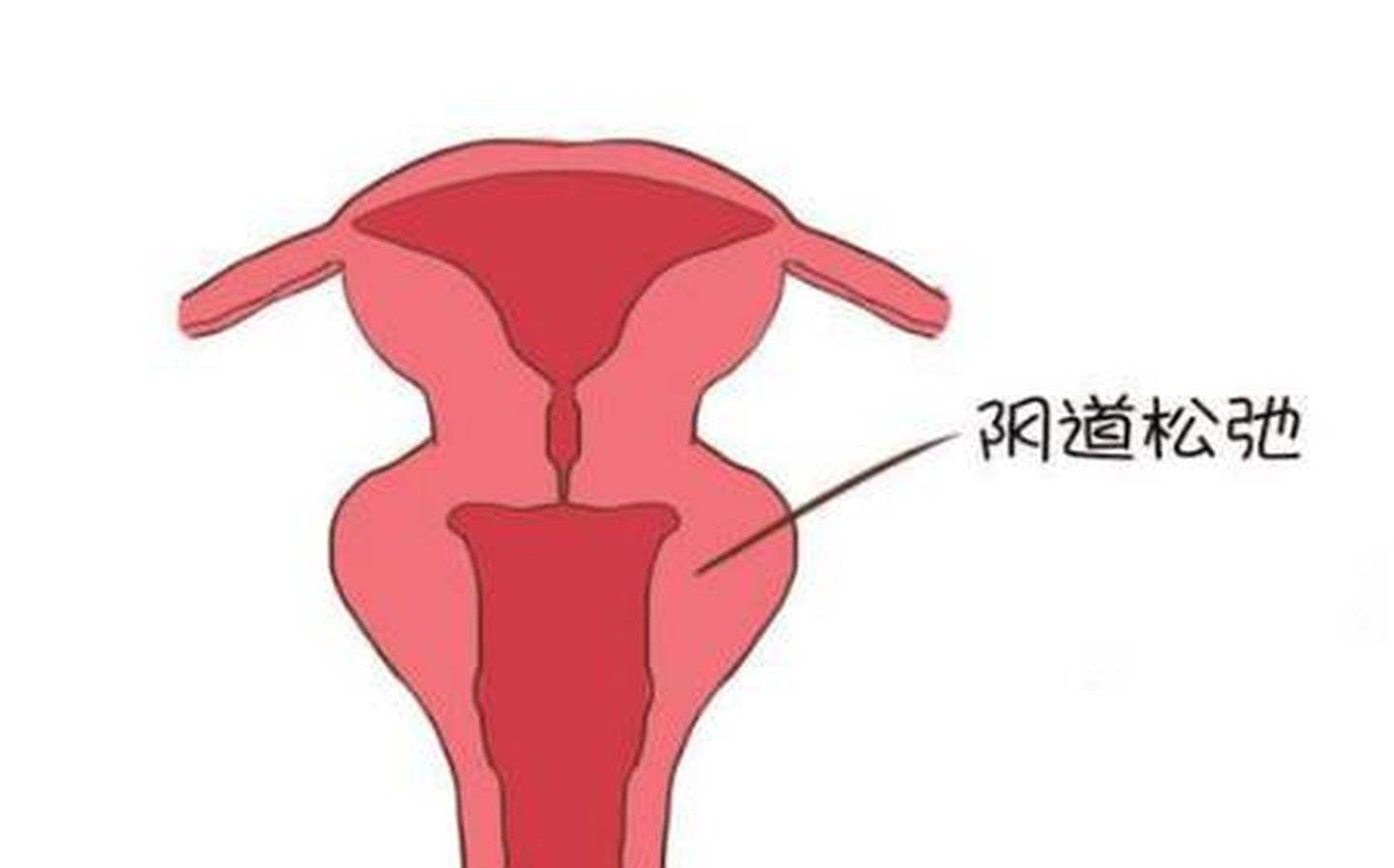缩阴