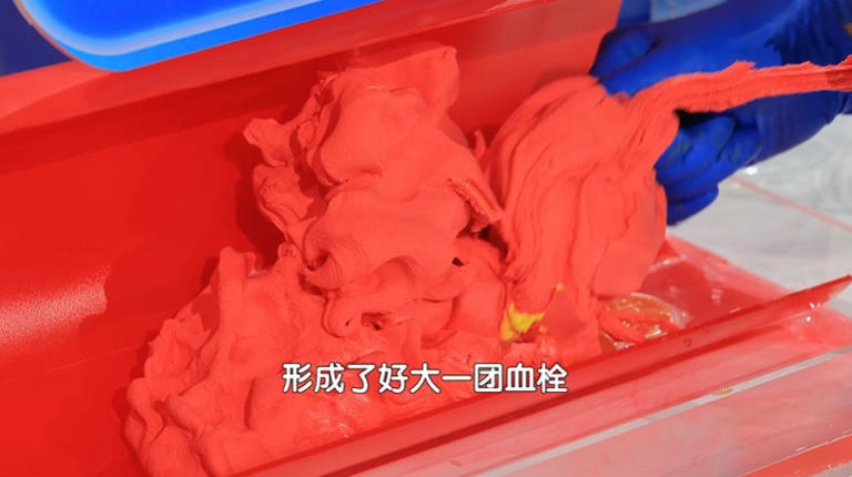 马上停止5类运动，很可能加速血栓形成，等血管“堵死”就迟了