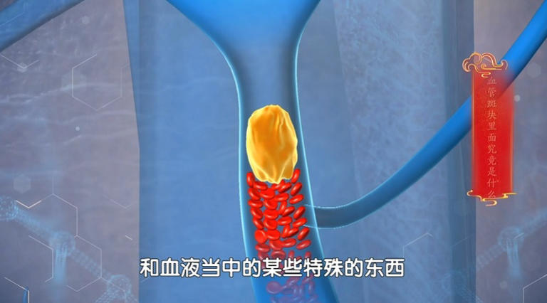 马上停止5类运动，很可能加速血栓形成，等血管“堵死”就迟了