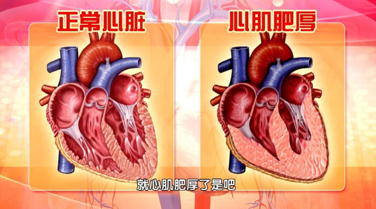 马上停止5类运动，很可能加速血栓形成，等血管“堵死”就迟了