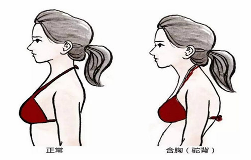 驼背让女性不再美丽，不再健康