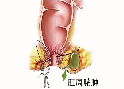肛周脓肿示意图