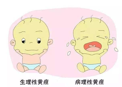 生理性黄疸
