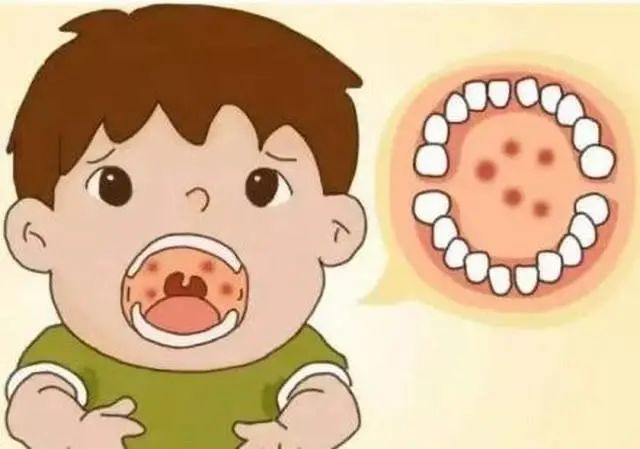 扁桃体发炎导致扁桃体肿大