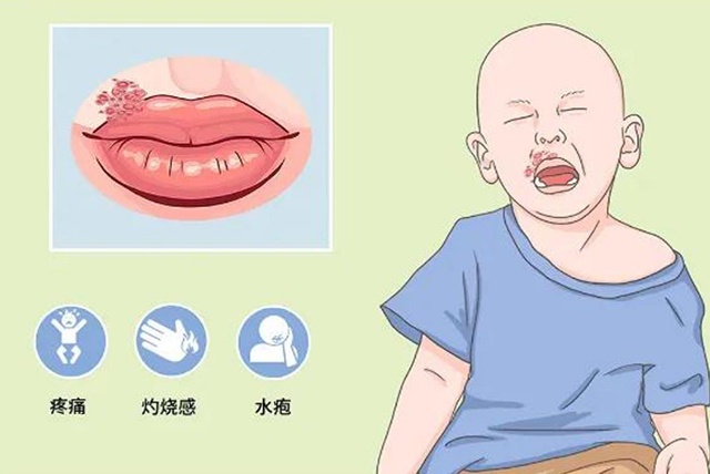 疱疹之单纯疱疹