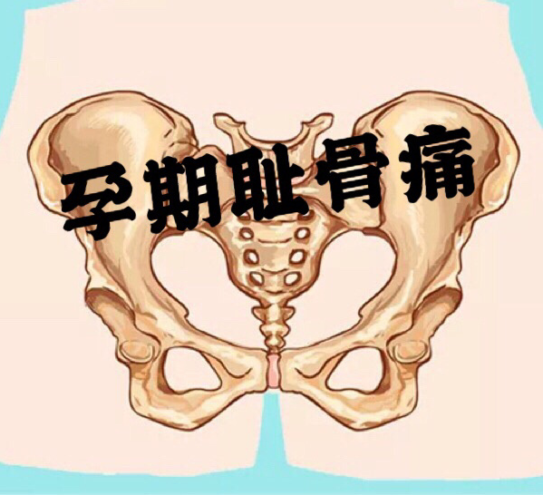 孕期耻骨痛