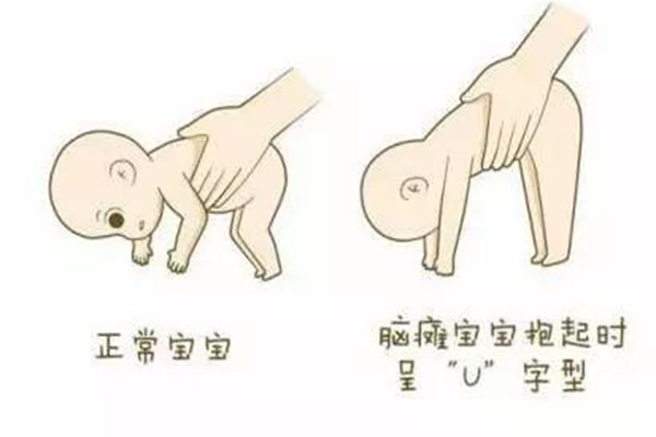 脑瘫儿