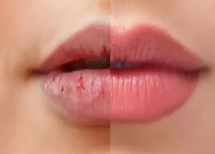 冬季如何预防嘴唇干裂脱皮