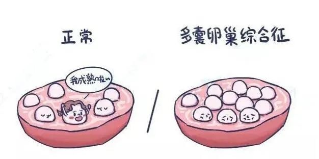 患上多囊卵巢综合征身体会出现什么异常现象？