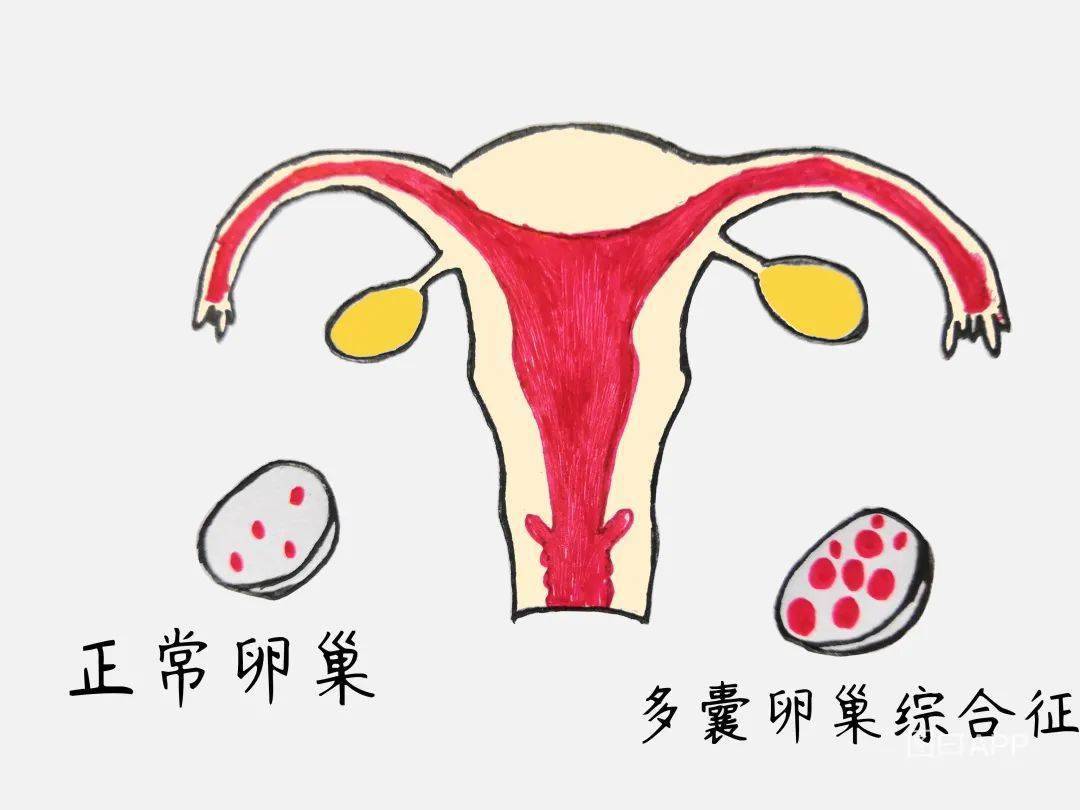 激素问题导致多囊卵巢