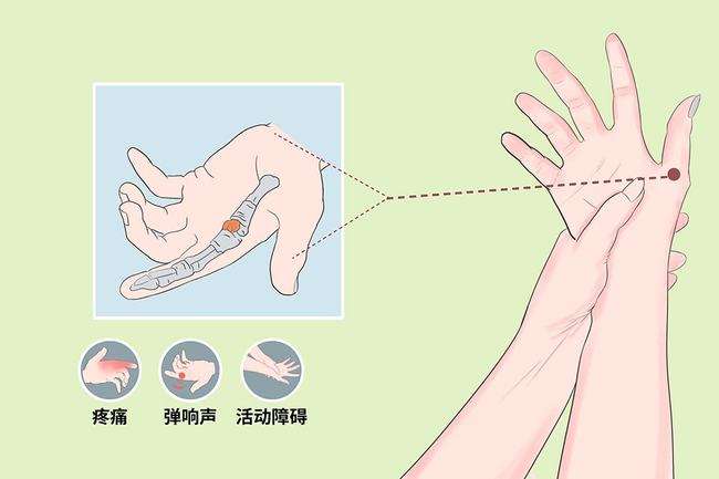 腱鞘炎导致手指疼痛