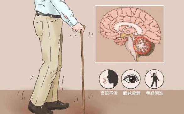 小脑萎缩会对人体产生什么影响？出现什么症状？