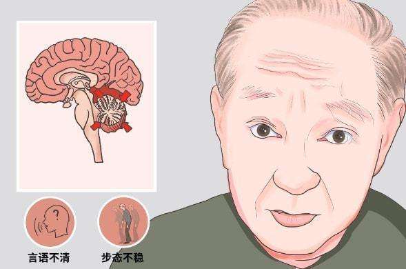 如何预防小脑萎缩？做好这几件事，小脑慢慢恢复