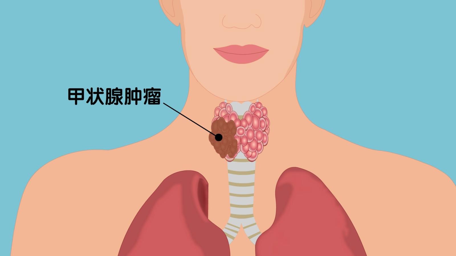 甲状腺癌是怎么形成的？这几个因素，或是诱发甲状腺癌的“催化剂”