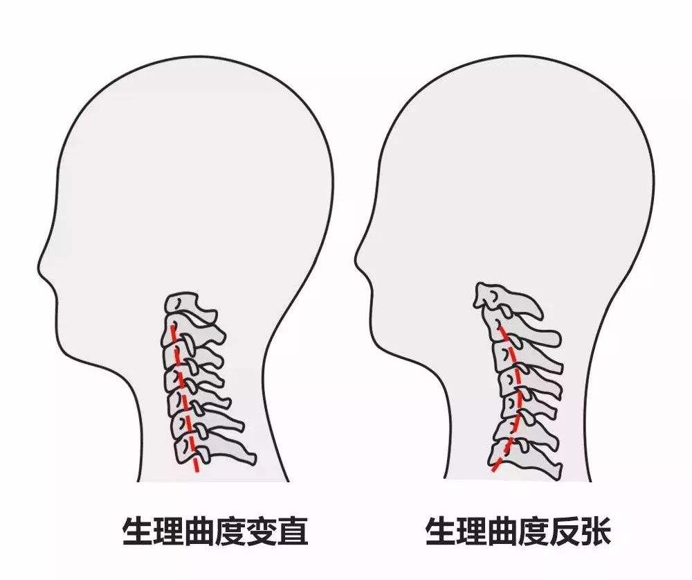 你的颈椎生病了吗？颈椎也是有自愈能力的！