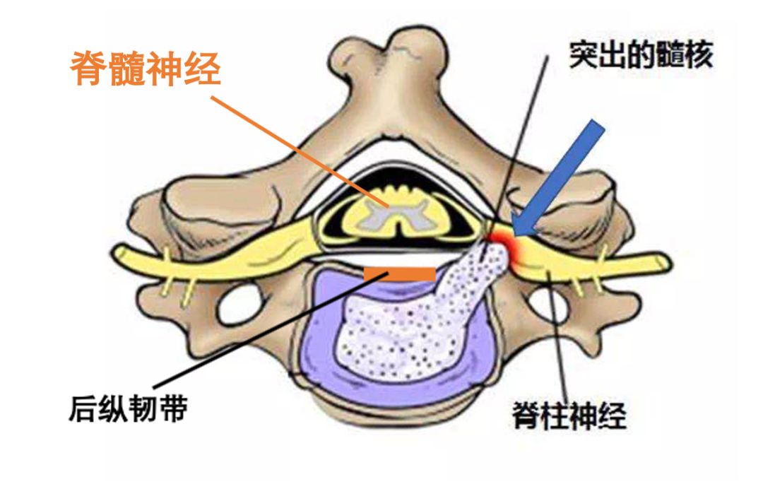 脊髓型颈椎病