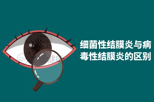 细菌性结膜炎与病毒性结膜炎的区别有哪些？两者有这些不同之处