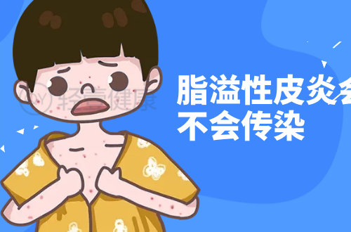 脂溢性皮炎会不会传染？