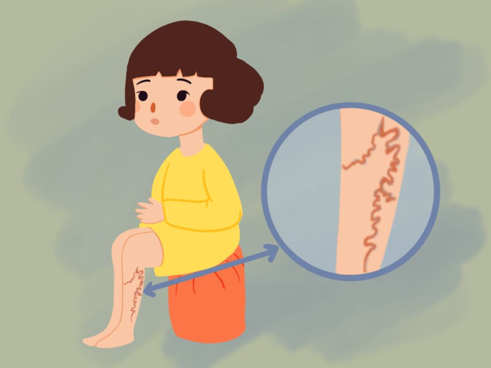 静脉曲张下肢水肿