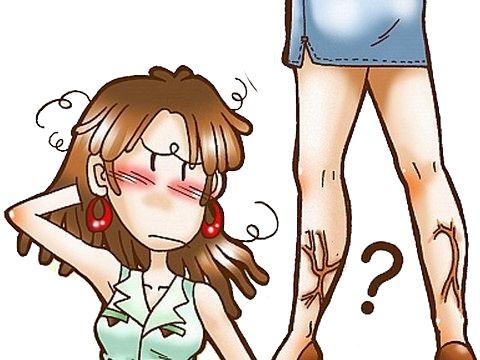 静脉曲张呈蚯蚓状
