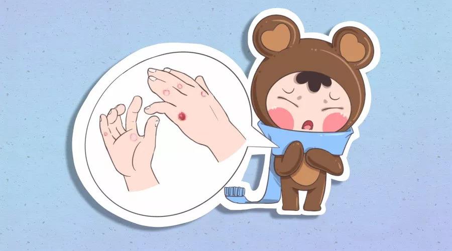 冻疮使得皮肤红肿