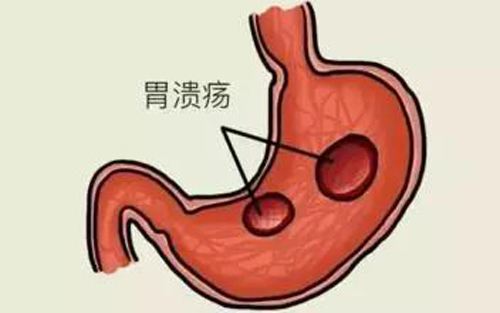 胃溃疡的症状表现有哪些？出现这8个症状，要及时就医