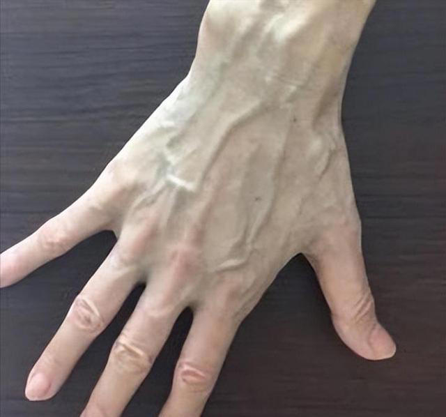 手背血管能看出寿命长短？医生：血管若有这些特征，恭喜你很健康