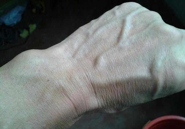 手背血管能看出寿命长短？医生：血管若有这些特征，恭喜你很健康