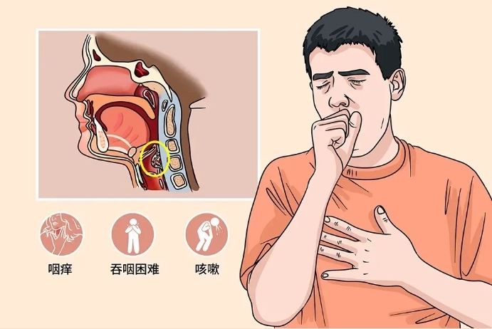 咽喉异物感一招见效