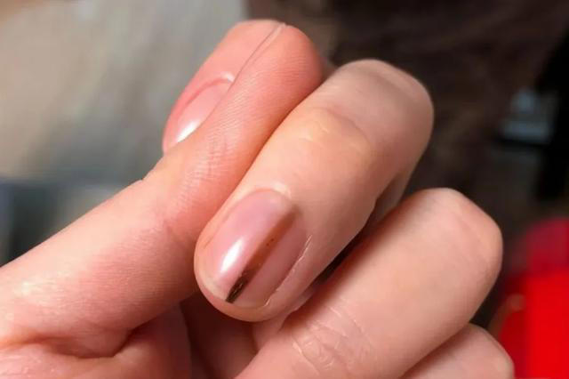 指甲若长成3种样子，可能是癌或疾病的信号，要引起重视