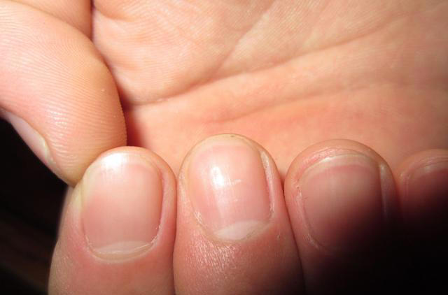 指甲若长成3种样子，可能是癌或疾病的信号，要引起重视