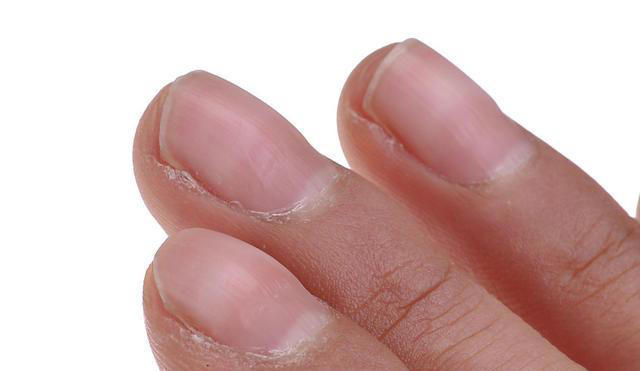 指甲若长成3种样子，可能是癌或疾病的信号，要引起重视