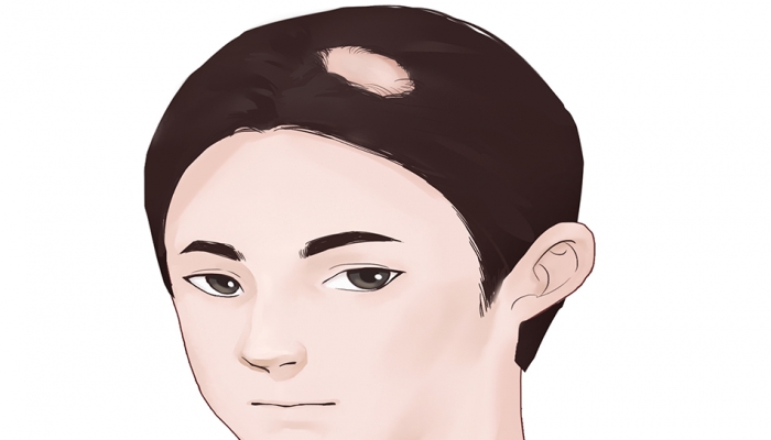 如何预防因雄激素引起的脱发 雄激素引起的脱发怎么办