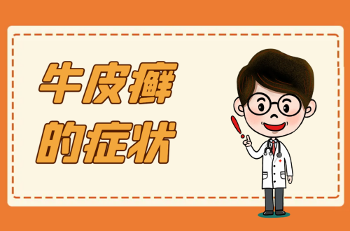 牛皮癣的症状有哪些？如何治疗？